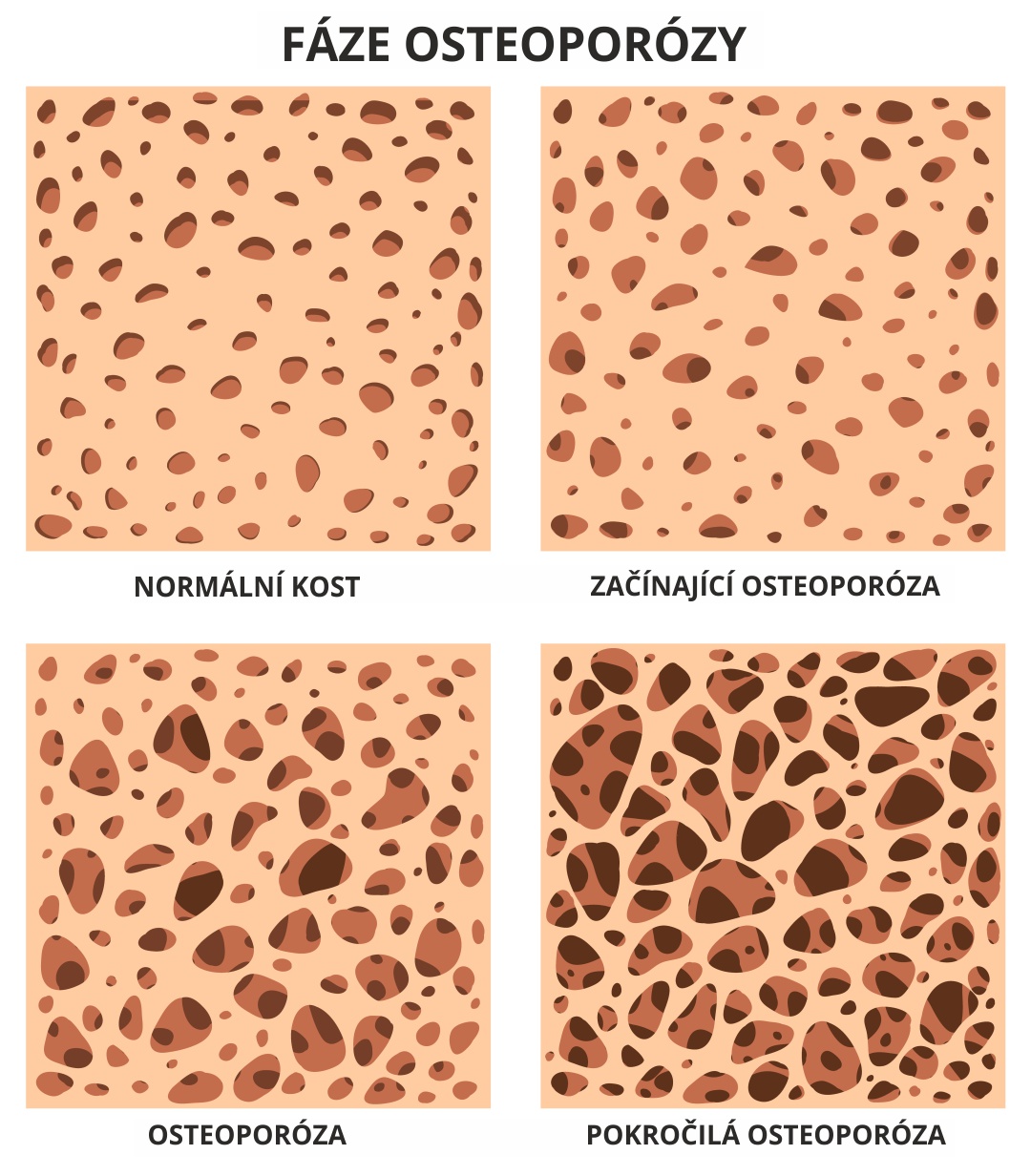 jaké jsou fáze osteoporózy